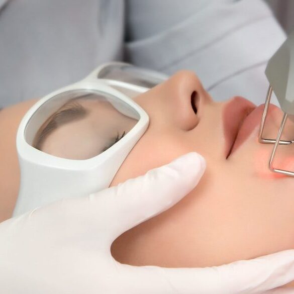 Fraksiyonel Lazer Fraksiyonel Lazer