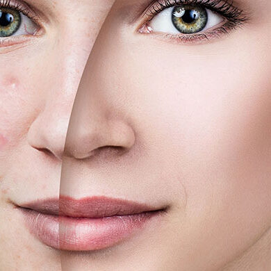 Leke Tedavisi Leke Tedavisi