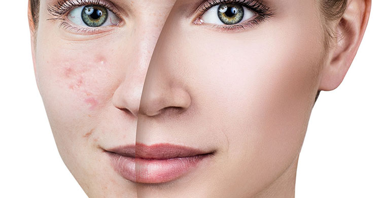 Leke Tedavisi Leke Tedavisi